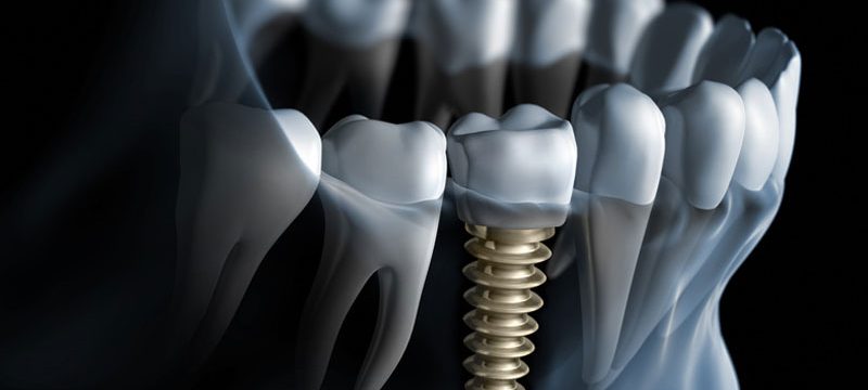 dental implants in Mumbai