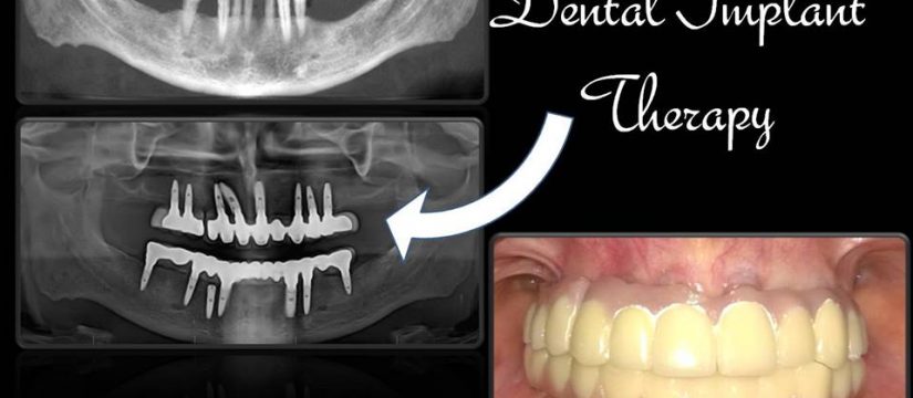 Dental Implant Therapy