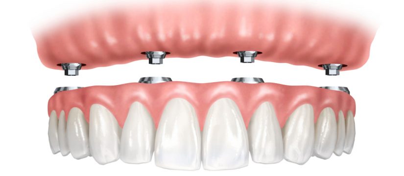 Dentures