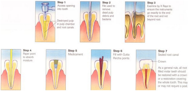 http://www.procaredental.co.in/wp-content/uploads/2017/01/Root-Canal-Treatment.png