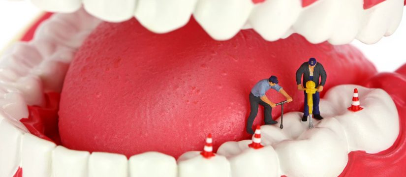 Root canal Treatment