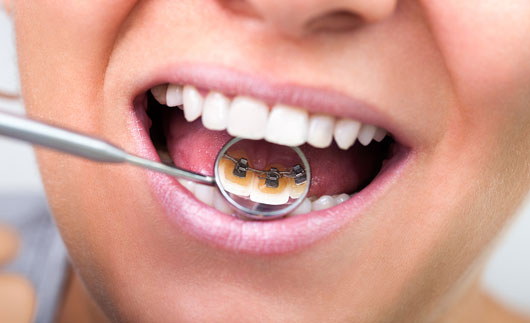 Teeth Alignment