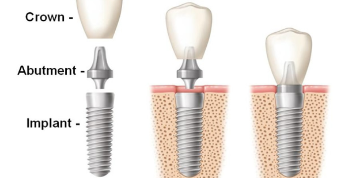 Dental Crown Treatment