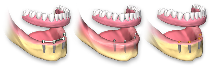 Full Arch Dental Treatment
