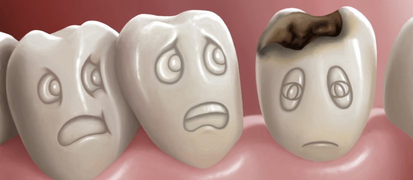 Tooth decay
