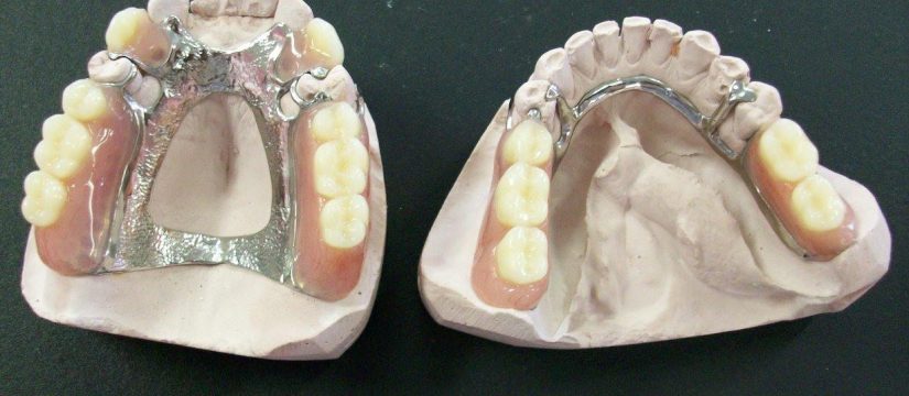partial-cast-dentures