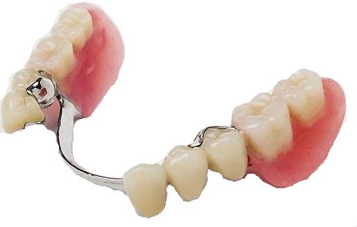 Single Arch in Denture